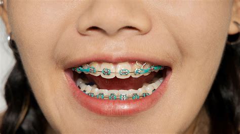 What's the Point of Rubber Bands on Braces? And Why Do They Sometimes Feel Like Tiny Slingshots?